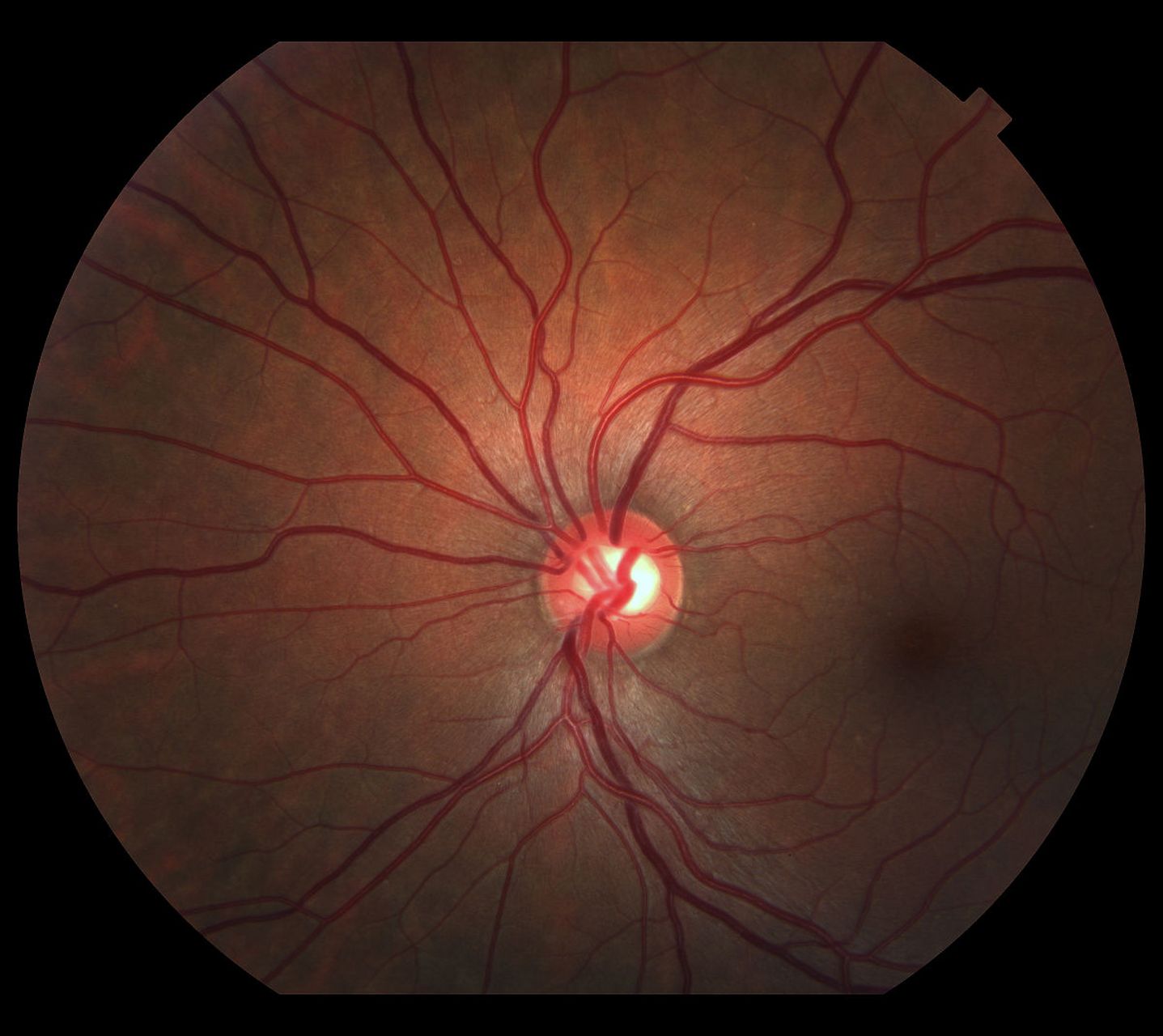 中医治疗糖尿病视网膜病变 典型病例举例 李xx,女,41岁.