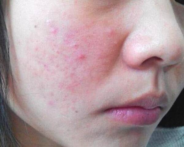 脸上突然长红疹?小伙伴们要注意