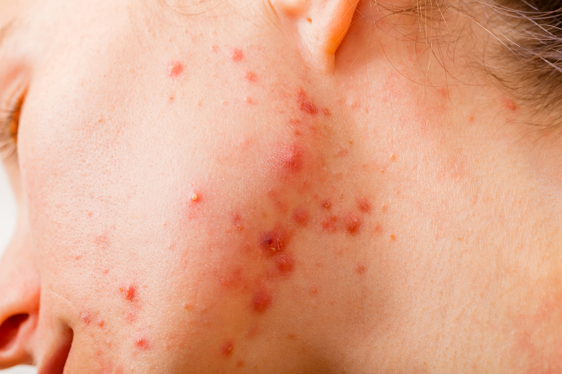 毛囊炎是许多人面临的常见皮肤问题,它导致脸上的痘痘和炎症,通过