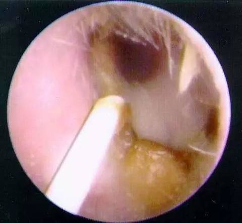 "狐臭"与"油耳朵"