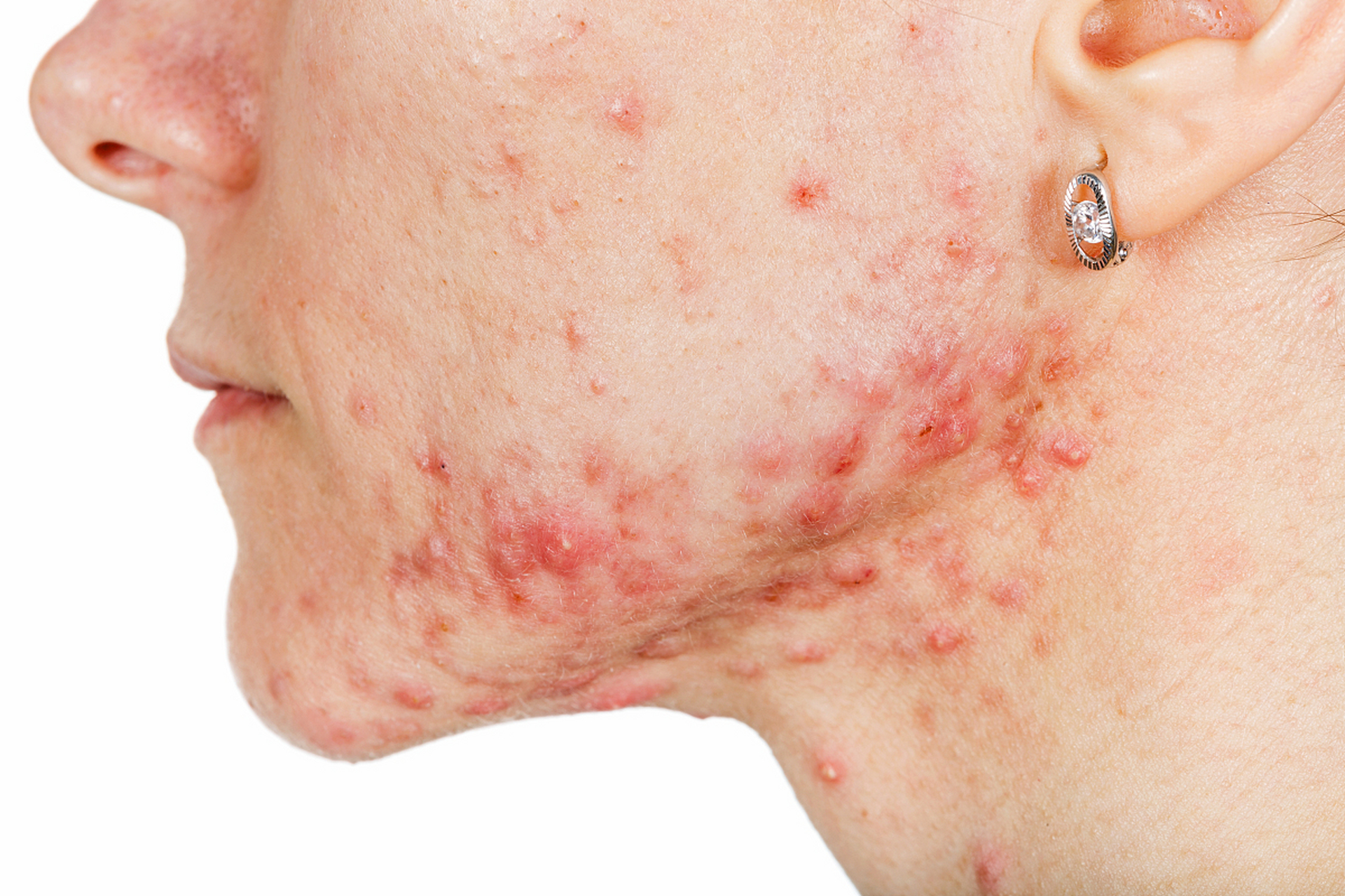 痘痘反反复复长了要怎么弄才能断根 #红蓝光祛痘