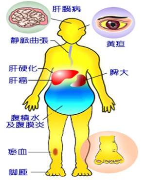 引发肝硬化有五种原因,四大并发症,在治疗和饮食上应