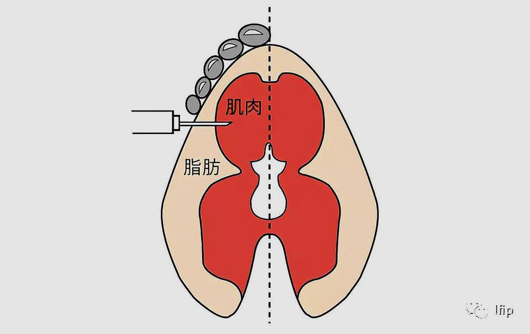 正确的肌肉注射方法