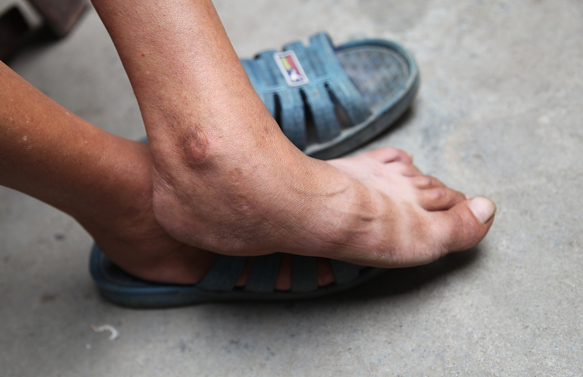 身体出现水肿,乏力,恶心等症状,可能是尿素超标的表现!