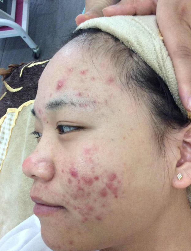 皮肤科专家告诫:女生脸上长痘痘,这三种行为才是"罪魁祸首!