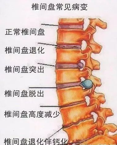 人体腰间盘位置图图片