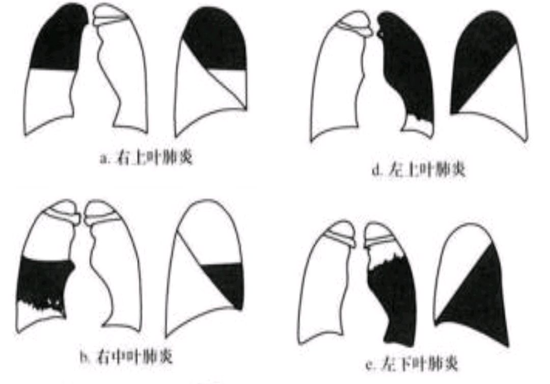 一字之差:大叶性肺炎和小叶性肺炎的区别