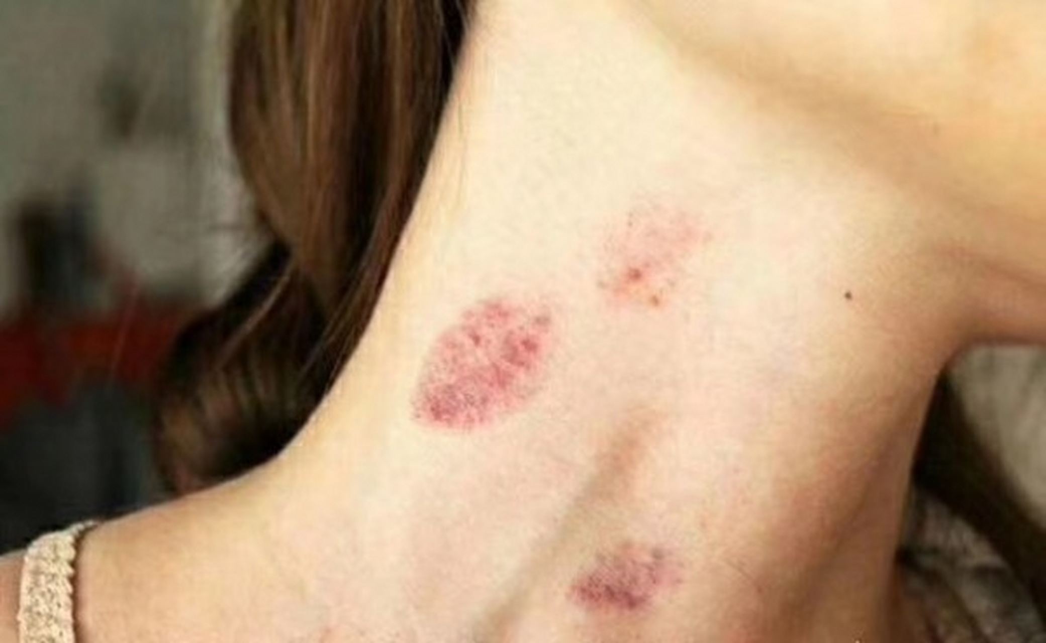 昨天女朋友在我脖子上种了一颗草莓印.