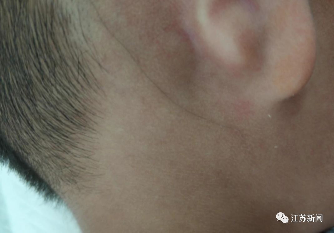 推荐@4岁男孩皮肤下有一根黑线，还会延长移动！医生惊了：中国仅3例