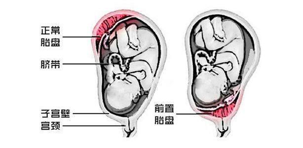 胎盘前壁和胎盘后壁有啥区别?三个区别很明显,跟胎儿性别没关系