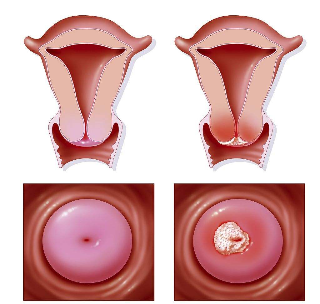 女性身体若出现这几种情况,可能是宫颈癌来"敲门"了,提早预防