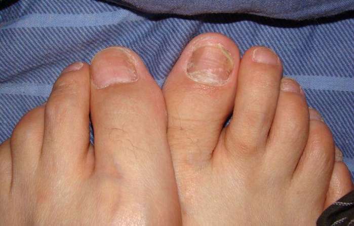 灰指甲的初期症状有什么?