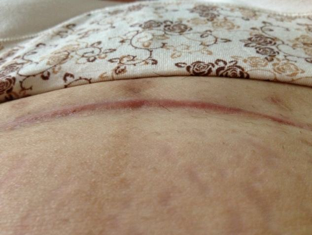 剖腹产的4个"后遗症",生二胎时才表现出来,很多孕妈都中招了