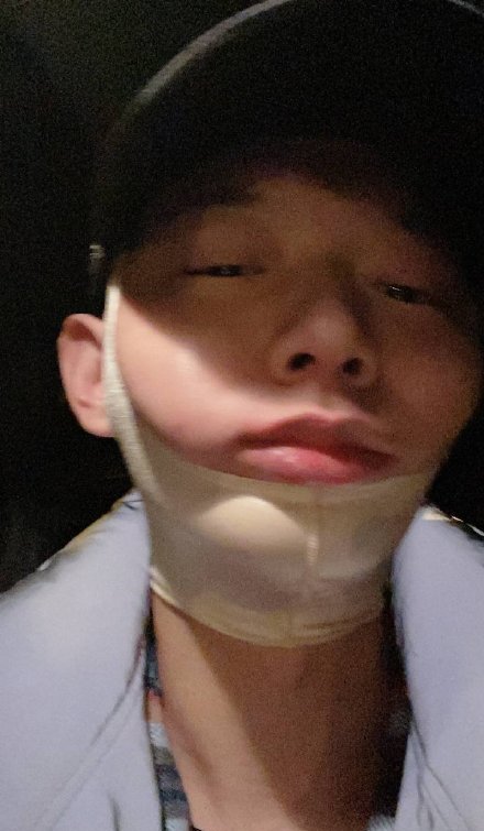 霍尊打哈欠致下巴脱臼后晒照报平安,脸部浮肿缠绷带不忘打坐喝茶
