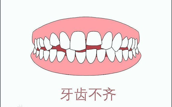 牙齿不齐什么时间矫治最合适?