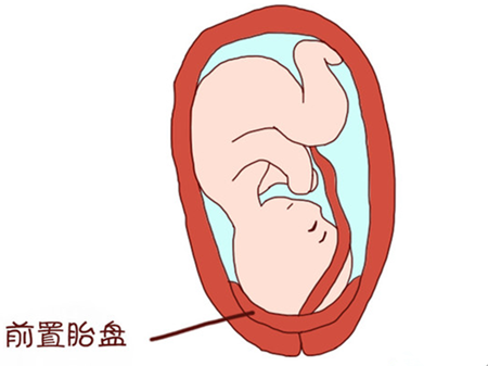 孕期若不注意这3点,可能会出现前置胎盘,而影响胎儿发育!