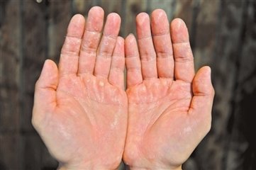 手脱皮吃什么维生素 解决方法你了解吗