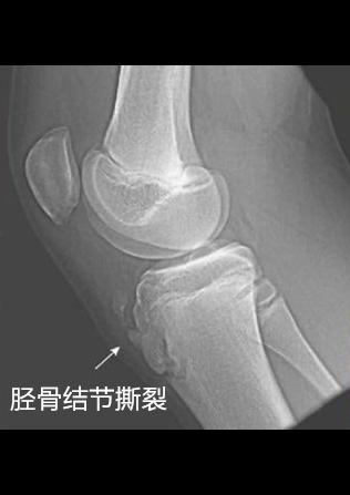 胫骨结节骨软骨病,不是生长痛,12~14岁膝盖下疼痛需要注意