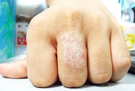 欢喜!过敏性湿疹怎么治疗"怎么易孕"-第1张图片-杰浩网