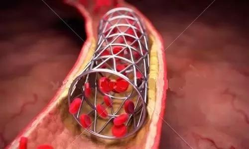 冠心病放支架图片图片