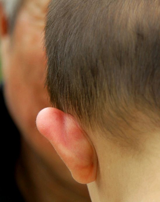 宝宝耳朵被蚊子咬肿了怎么办?能用芦荟吗?