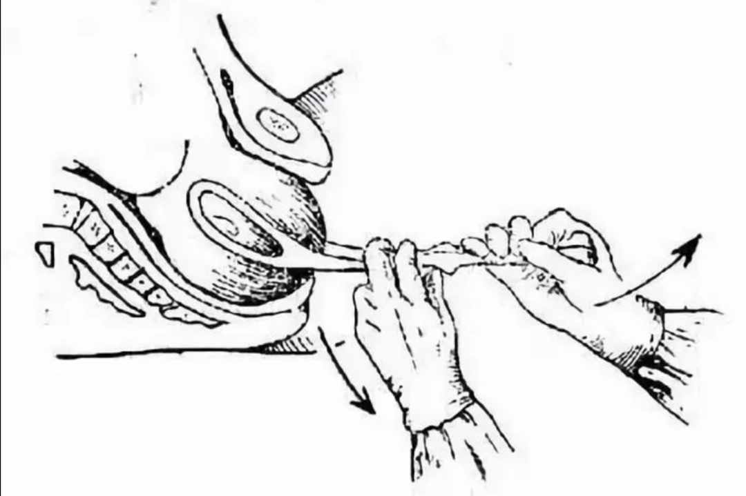 4个月宝宝"产钳伤"未消,院方回应:只有两种情况下才会用产钳