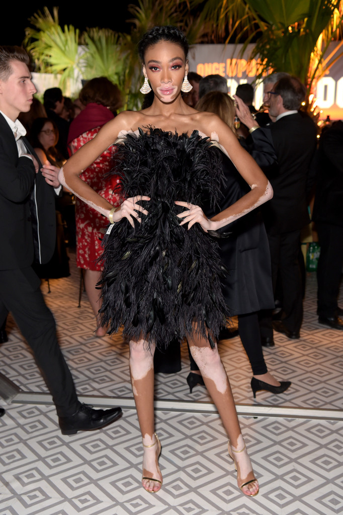 全球首位"白癜风超模"温妮·哈洛,用自己的"丑"带来高级时尚