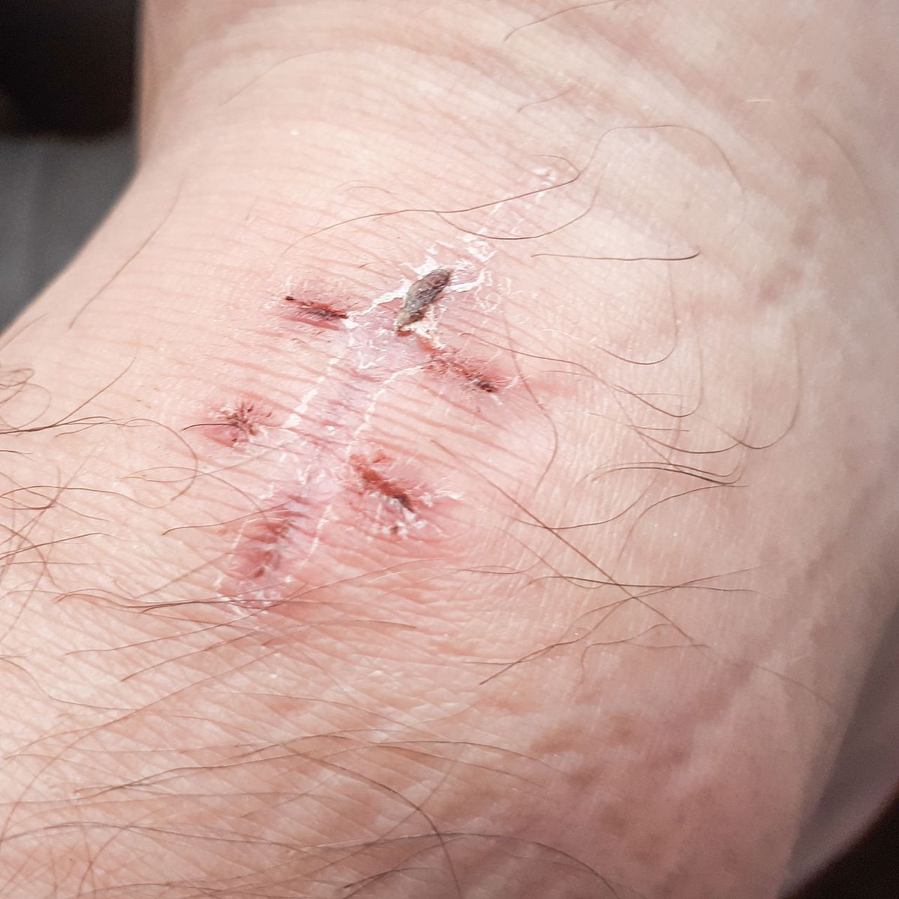 红色疤痕多久能恢复正常肤色  红色疤痕通常是由于血液循环增加和组织