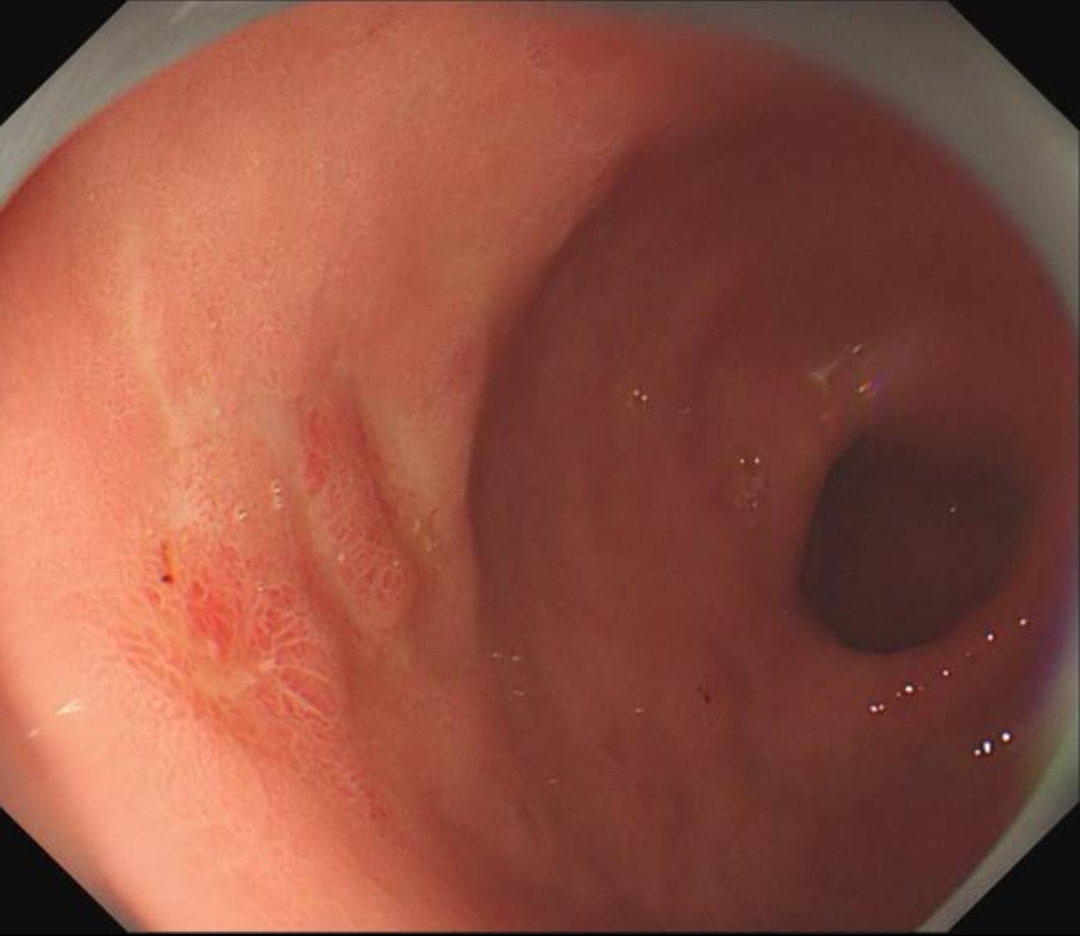 胃癌中期胃镜图片图片