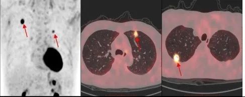 揭开「现代医学高科技之冠」PET/CT 的神秘面纱