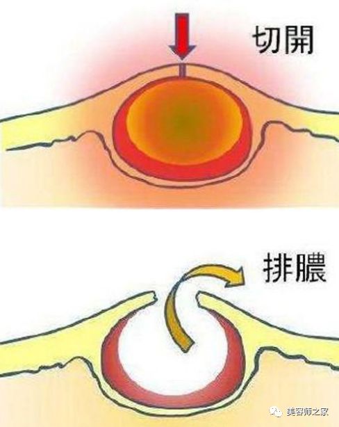 耳朵后面长疙瘩,这几种情况要注意!