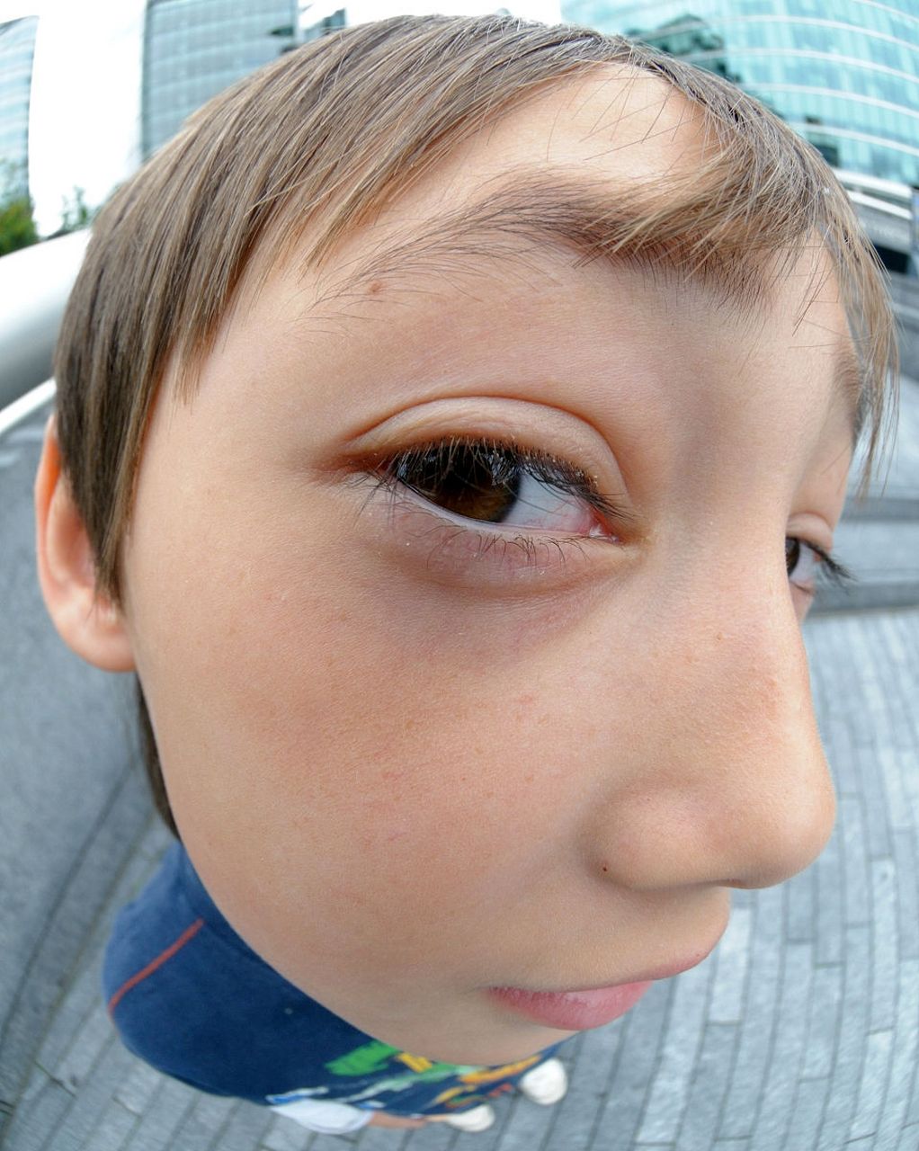 甲亢突眼症怎么办?