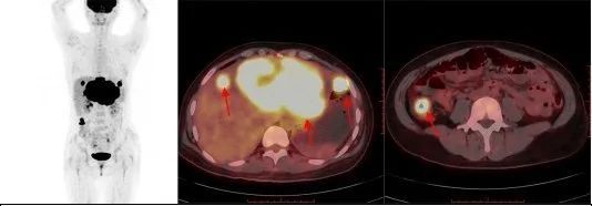 揭开「现代医学高科技之冠」PET/CT 的神秘面纱