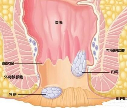 痔疮能不能自愈得看是内痔还是外痔?治疗原则是什么?