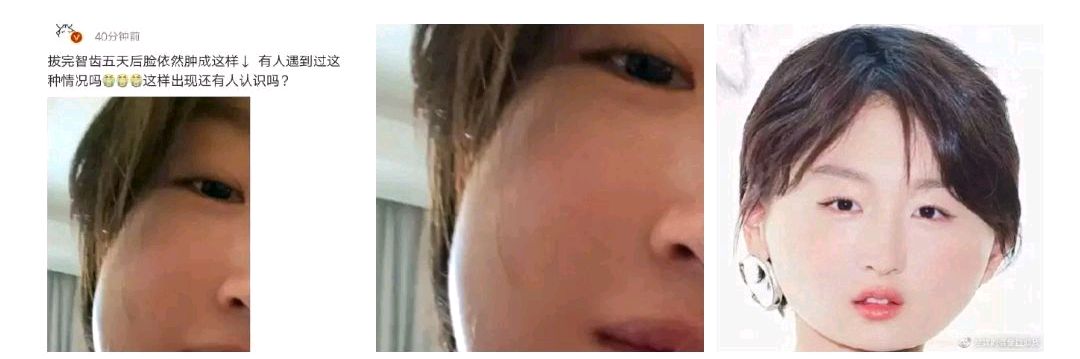 明星都逃不过拔智齿