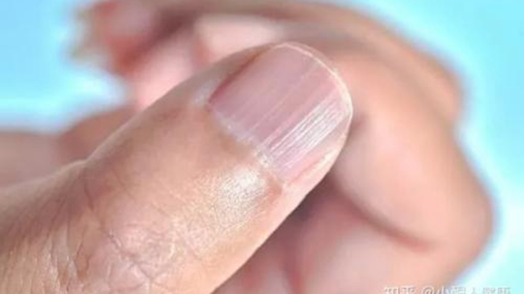 指甲竖纹当心三大疾病图片