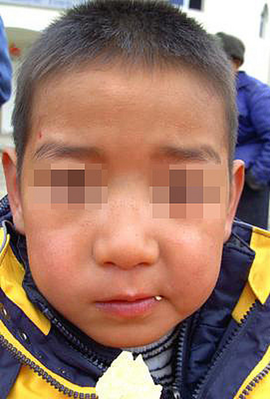 颌面囊肿一定要手术吗    	颌面囊肿一般指口腔颌面部囊肿,通常情况下