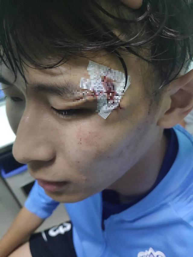 单鹏飞眼角被撞成v型 半场送医缝数十针