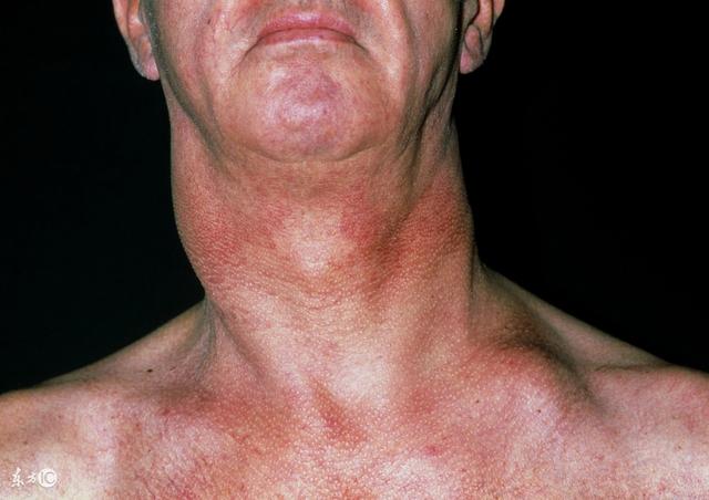 扁桃体发炎也会淋巴结肿大,下颚有疙瘩是淋巴毒素多