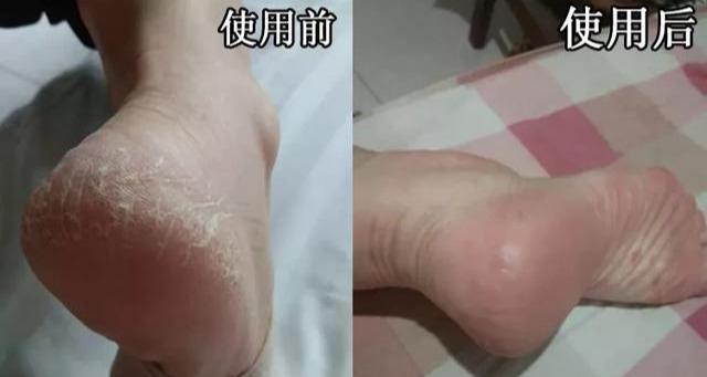 小腿鱼鳞皮肤怎么消除图片