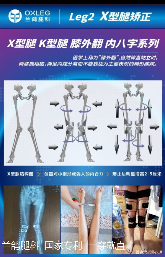 矫正o型腿
