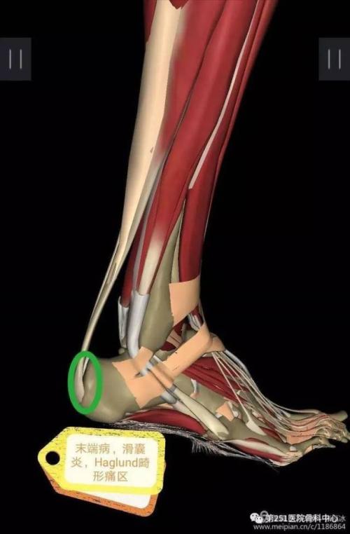 跟腱准确位置图图片