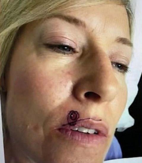 加拿大一女子嘴唇上方有个痘 一查竟是皮肤癌