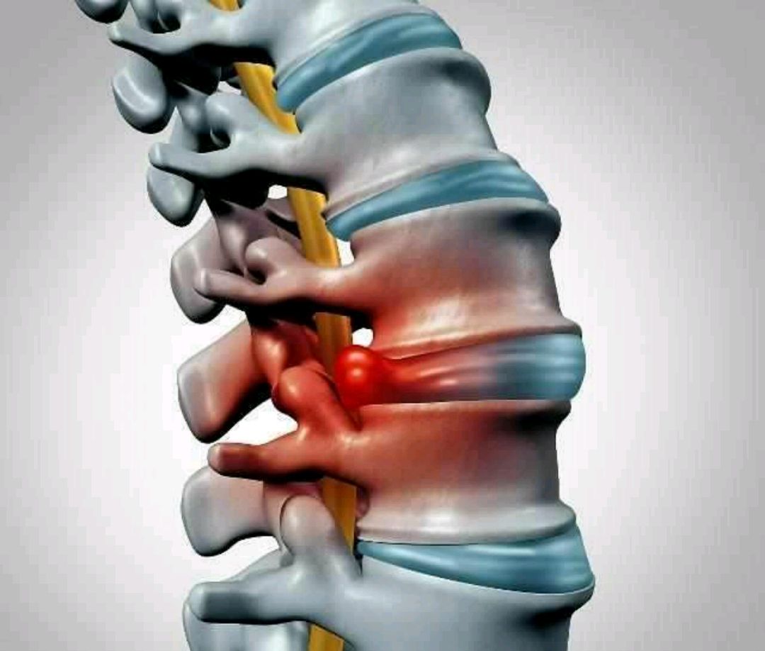 腰椎間盤突出怎麼治療?這幾個方法你要知道