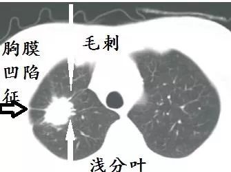 引起胸膜凹陷,烂糟糟的空洞,吸血鬼征:血管向肿块聚拢,以供肿瘤吸血