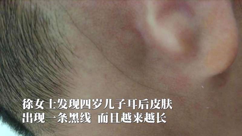 毛发在皮下“游走” 徐州4岁男孩患上罕见病