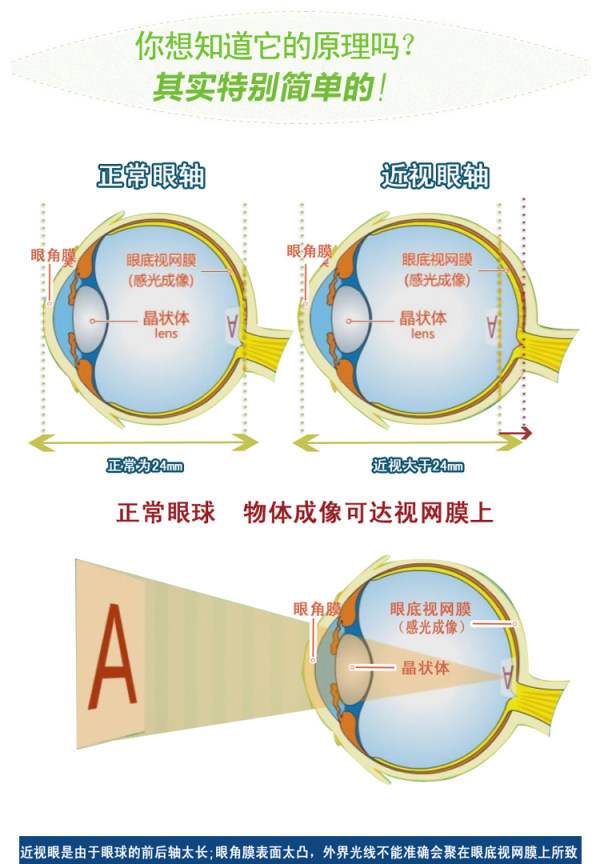 12歲小孩近視200度,可以不治療,通過鍛鍊恢復嗎?