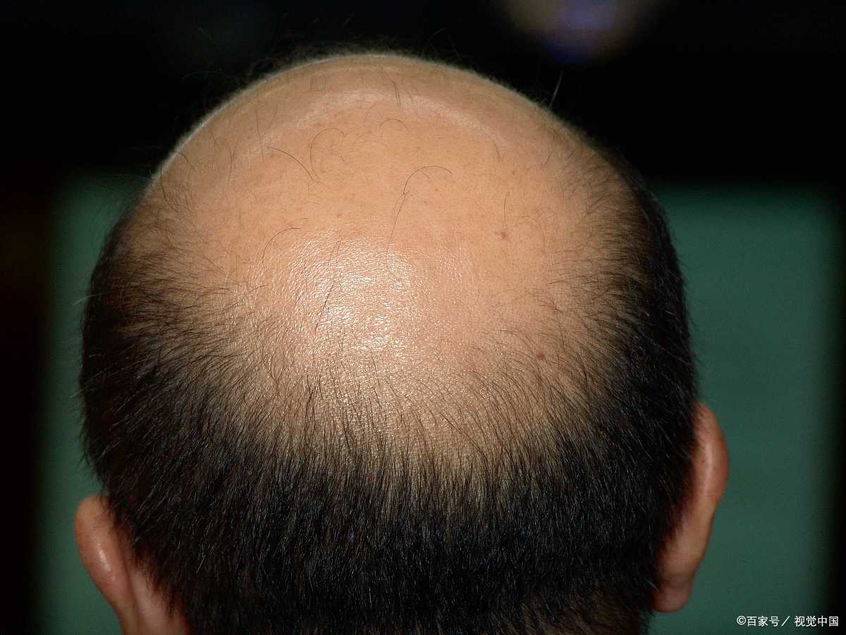 为何会祖传秃顶你遗传秃顶的概率有多高