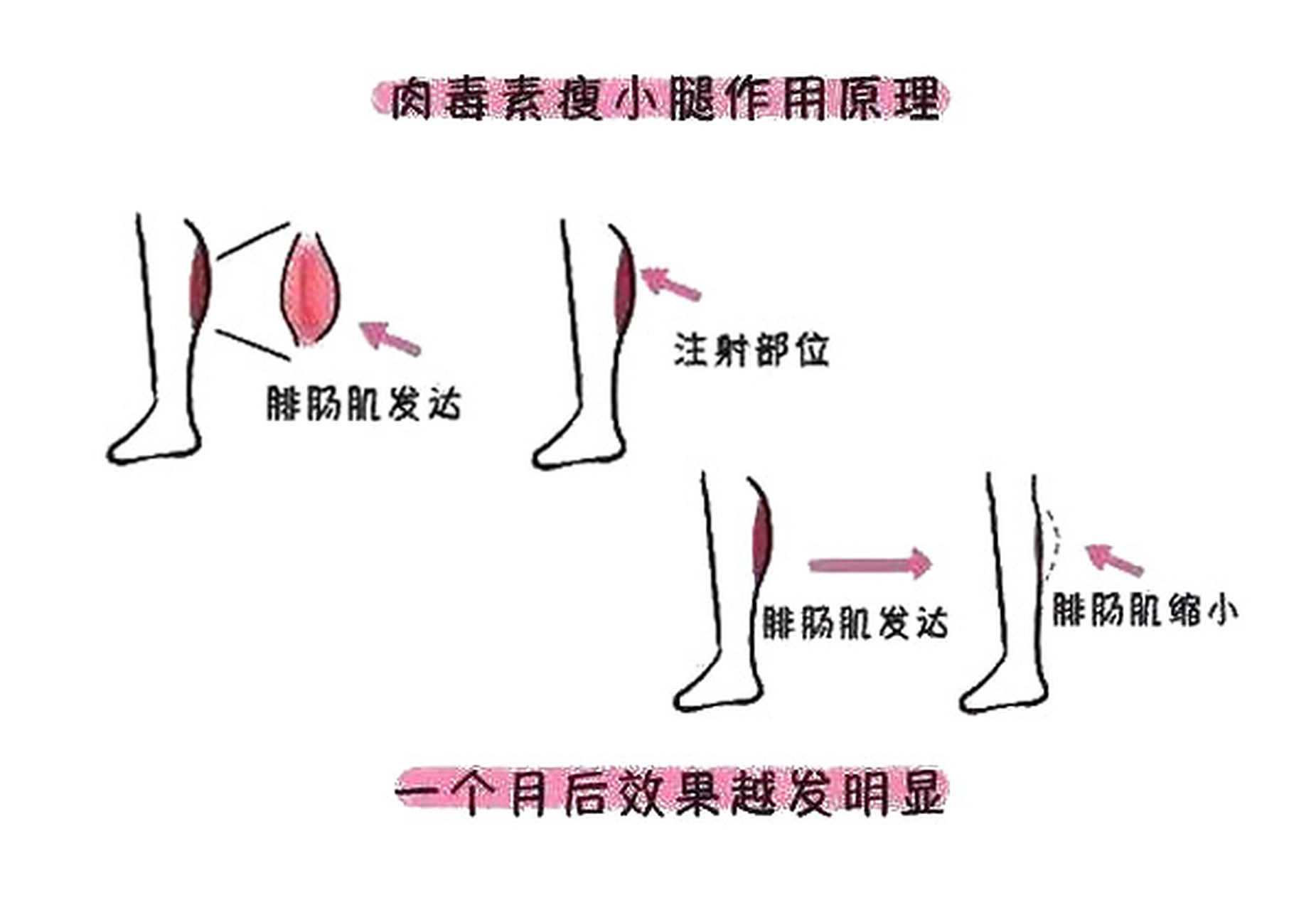 在减肥这个大队伍当中,最难减的要数小腿上面的肌肉了. 肉毒素瘦小腿,