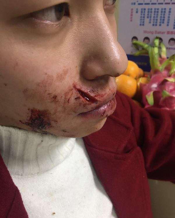 抓肇事者!男子金新路吃宵夜,莫名其妙被醉汉用碗砸脸缝了20针!